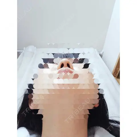 鼻尖形成（切開） / 鼻尖縮小 / ヒアルロン酸注入（鼻） 東京形成美容外科 船橋院 AFTER