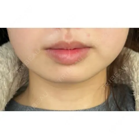 ボトックス（あご） / ボトックス（エラ・小顔） ルラ美容クリニック 新宿院 AFTER