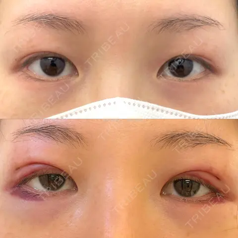 二重埋没 / 上まぶたの脂肪取り 湘南美容クリニック 上野院 DAY 2