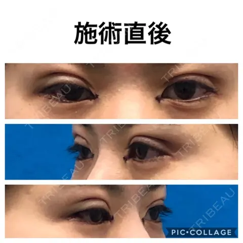 二重埋没 / 目頭切開 / 上まぶたの脂肪取り TCB東京中央美容外科 仙台駅前院 DAY 0