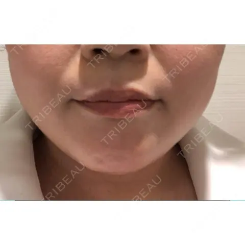 脂肪溶解注射（顔） あいち栄クリニック DAY 0