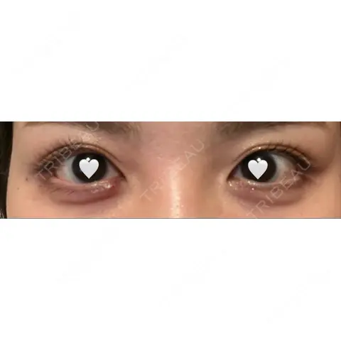 ヒアルロン酸注入（涙袋） MSC LUNA CLINIC 渋谷院 AFTER
