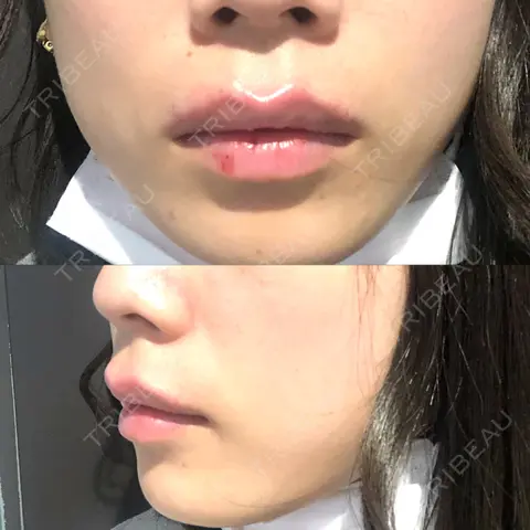 ヒアルロン酸注入（唇） / ボトックス（口角） MSC LUNA CLINIC 渋谷院 AFTER