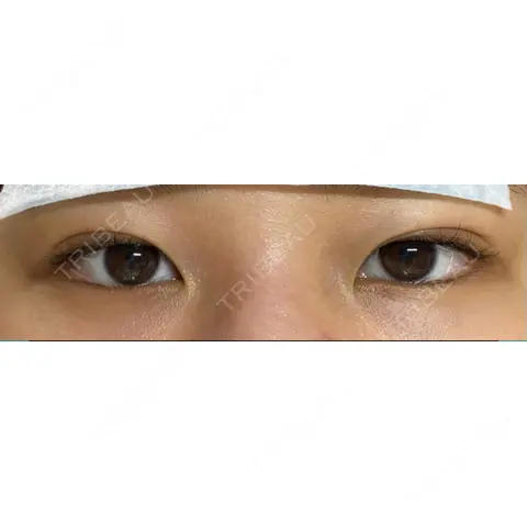 二重埋没 MSC LUNA CLINIC 渋谷院 DAY 0