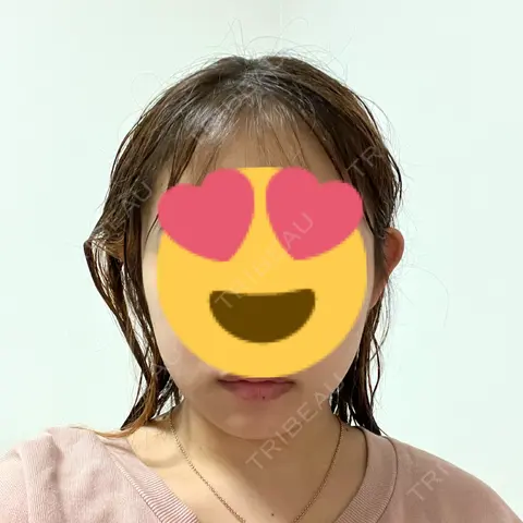 糸リフト / 脂肪吸引（顔） / ボトックス（エラ・小顔） ヴェルトラクリニック 大阪院 AFTER