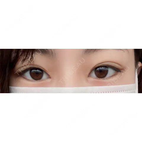 二重埋没 / 目頭切開 / 上まぶたの脂肪取り 湘南美容クリニック 上野院 AFTER