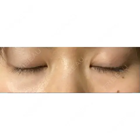 二重埋没 湘南美容クリニック 上野院 AFTER