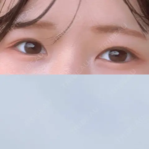 二重切開 水の森美容クリニック 東京銀座院 AFTER