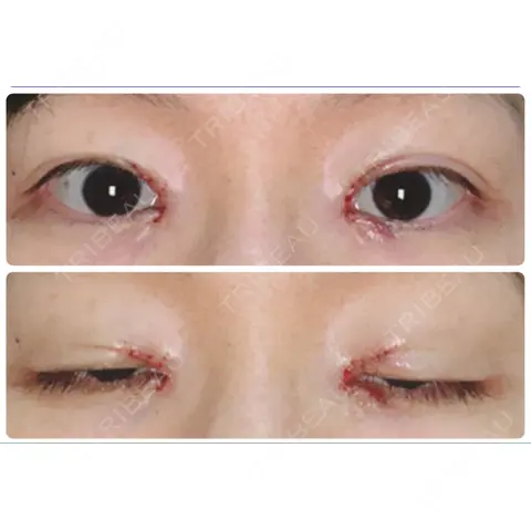 目頭切開 いちのせ形成外科・皮膚科 眼瞼＆フェイスクリニック DAY 0