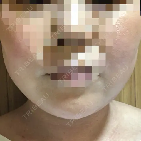 脂肪溶解注射（顔） あいち栄クリニック DAY 0