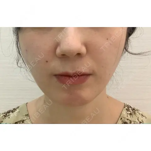 バッカルファット除去 / 脂肪吸引（顔） / ボトックス（エラ・小顔） WOM CLINIC GINZA （ワム クリニック ギンザ） AFTER