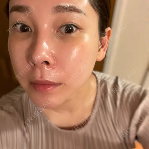 ヴェルヴェットスキン MSC LUNA CLINIC 渋谷院 AFTER