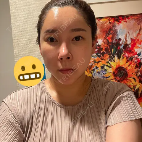 ヴェルヴェットスキン MSC LUNA CLINIC 渋谷院 AFTER