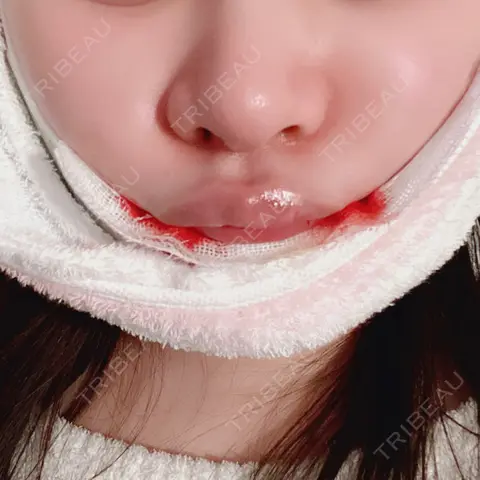 バッカルファット除去 / ジョールファット除去 ルラ美容クリニック 高田馬場院 DAY 0