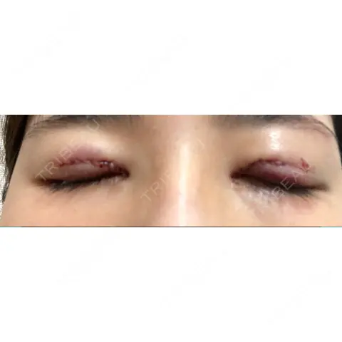 二重切開 / 目頭切開 / 眼瞼下垂（切開） いちのせ形成外科・皮膚科 眼瞼＆フェイスクリニック DAY 0