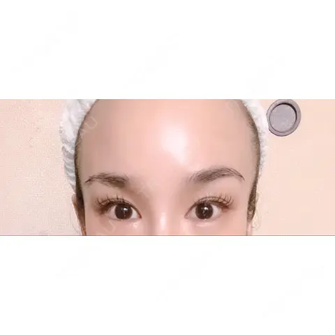 ハイフ（顔） / その他（目元） ロナロナクリニック AFTER