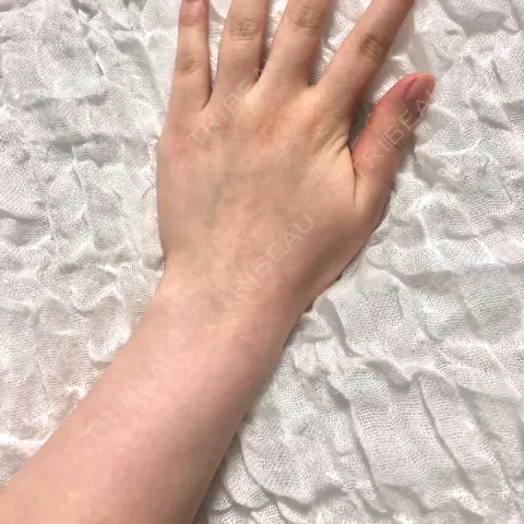 脂肪吸引（二の腕） 湘南美容クリニック 千葉センシティ院 DAY 0