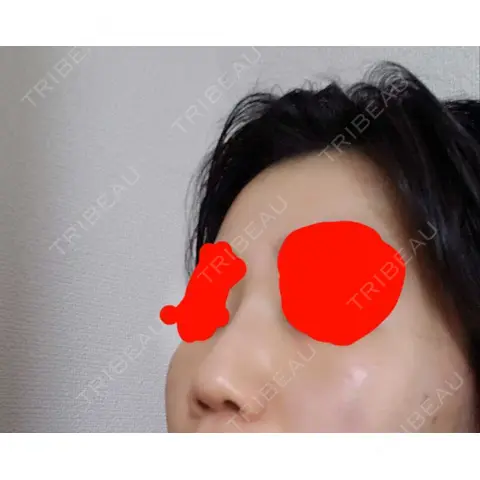 ヒアルロン酸注入（鼻） アクトリー勝どきウェルネスメディカルクリニック AFTER