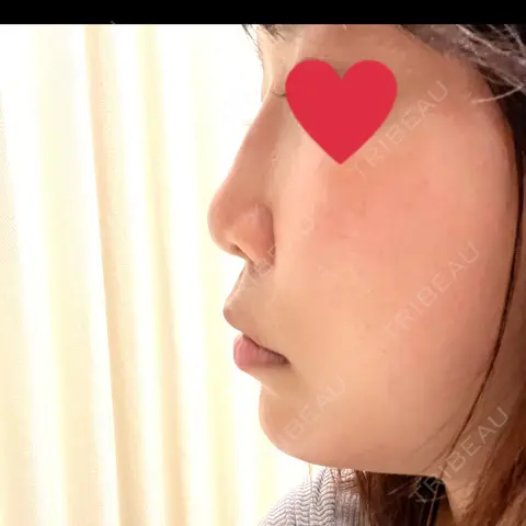 ヒアルロン酸注入（鼻） / ヒアルロン酸注入（あご） / その他 ルラ美容クリニック 千葉院 DAY 0