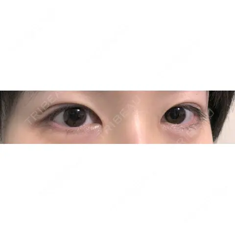 目頭切開 / タレ目形成・グラマラスライン（切開） / ヒアルロン酸注入（涙袋） 東京エビスクリニック AFTER
