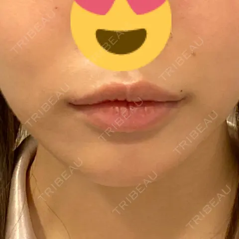 ヒアルロン酸注入（唇） / ボトックス（口角） ルラ美容クリニック 新宿院 DAY 0