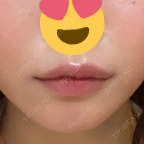 ヒアルロン酸注入（唇） / ボトックス（口角） ルラ美容クリニック 新宿院 AFTER
