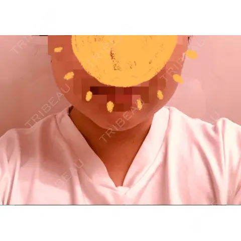 脂肪溶解注射（顔） あいち栄クリニック AFTER