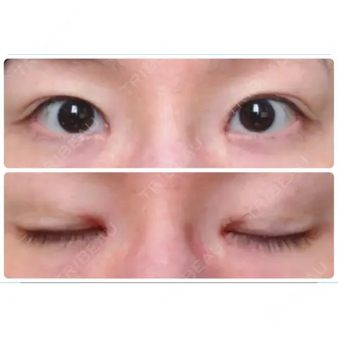 目頭切開 いちのせ形成外科・皮膚科 眼瞼＆フェイスクリニック AFTER