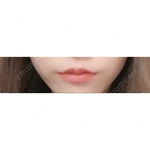 ヒアルロン酸注入（唇） / ボトックス（口角） MSC LUNA CLINIC 渋谷院 AFTER