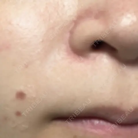 ほくろ・いぼ切除（肌） Fellez Clinic【フェルズクリニック】 AFTER