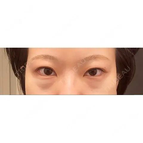 下まぶたの脂肪取り APOLLO BEAUTY CLINIC DAY 0