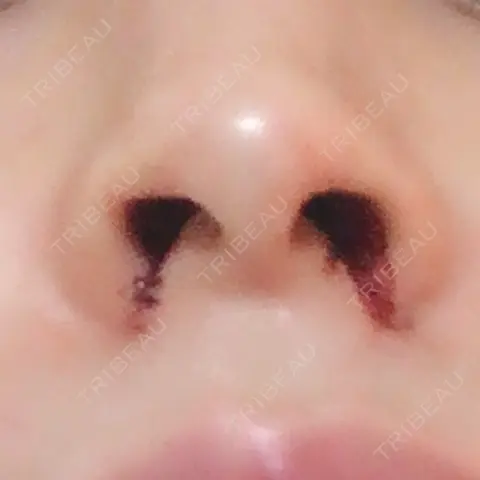 小鼻縮小（切開） 湘南美容クリニック 秋葉原院 DAY 0