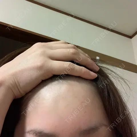 ヒアルロン酸注入（額） / ボトックス（眉間） TCB東京中央美容外科 郡山院 AFTER