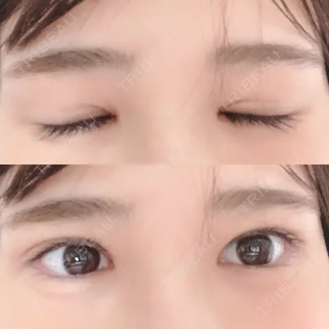 二重切開 / 目頭切開 / 眼瞼下垂（切開） いちのせ形成外科・皮膚科 眼瞼＆フェイスクリニック AFTER