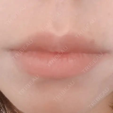 ボトックス（人中） AILE Clinic AFTER