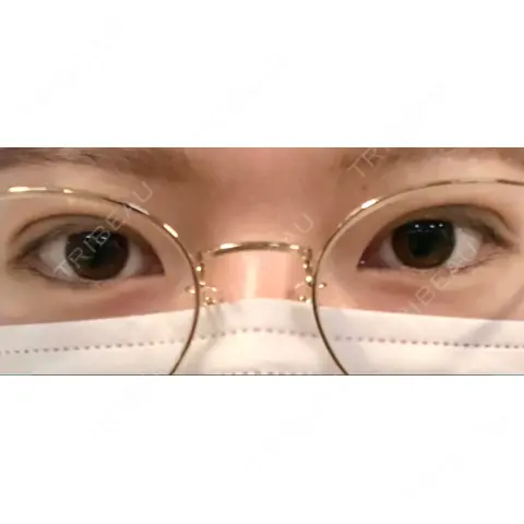 二重埋没 / 上まぶたの脂肪取り 湘南美容クリニック 上野院 DAY 0