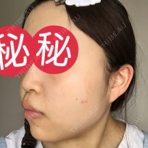 シミ取りレーザー 南青山TOKUNAKAクリニック AFTER