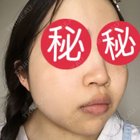 シミ取りレーザー 南青山TOKUNAKAクリニック AFTER