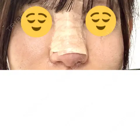 隆鼻術 JUN CLINIC DAY 1