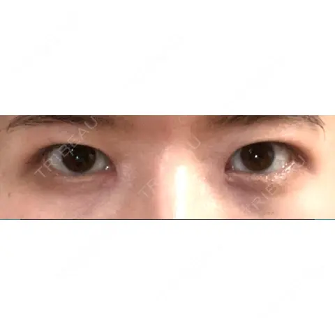 二重切開 / 目頭切開 / 眼瞼下垂（切開） いちのせ形成外科・皮膚科 眼瞼＆フェイスクリニック AFTER