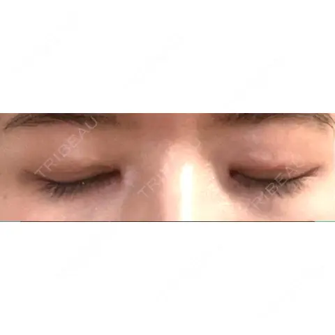 二重切開 / 目頭切開 / 眼瞼下垂（切開） いちのせ形成外科・皮膚科 眼瞼＆フェイスクリニック AFTER