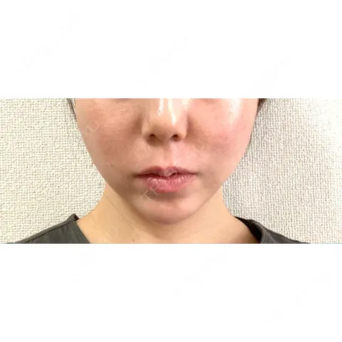 糸リフト 新宿TAクリニック AFTER