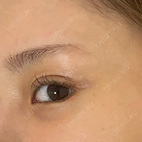 ほくろ・いぼ除去レーザー（肌） Fellez Clinic【フェルズクリニック】 AFTER