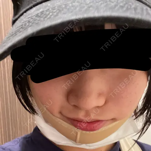 脂肪吸引（顔） ルラ美容クリニック 大阪本院 DAY 0