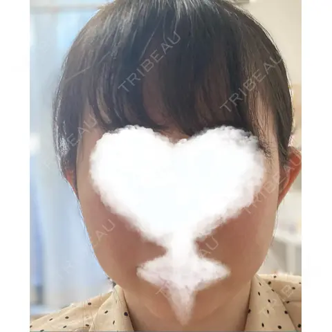 糸リフト ノーチェビューティクリニック AFTER