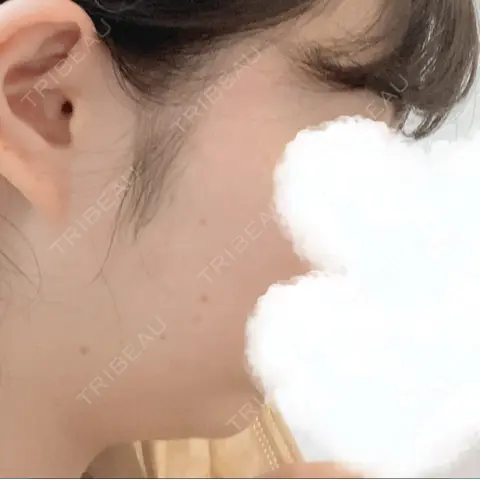 糸リフト ノーチェビューティクリニック AFTER