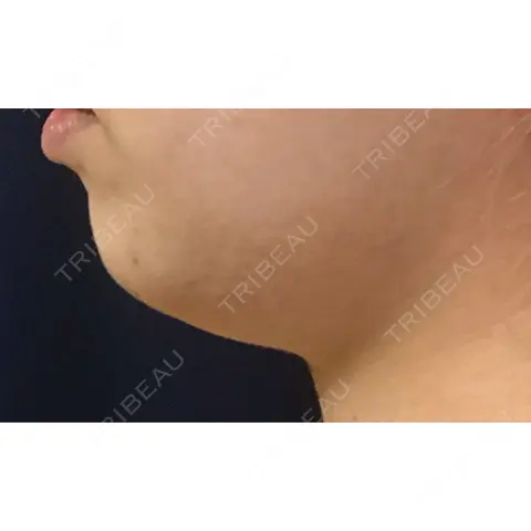 脂肪溶解注射（顔） 東京ロイヤルクリニック AFTER