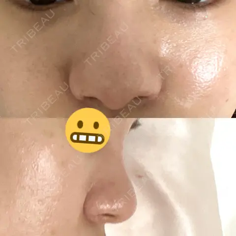 隆鼻術 JUN CLINIC AFTER