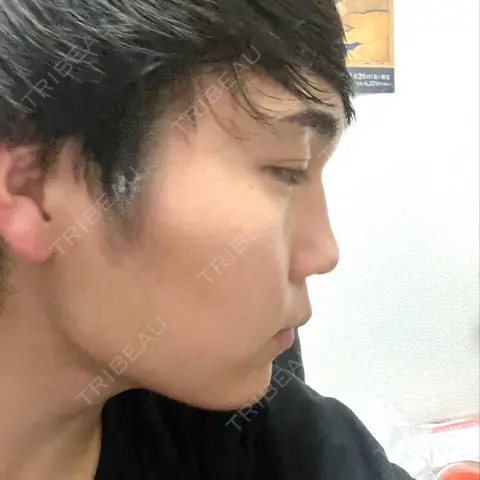 二重埋没 / 糸リフト / ヒアルロン酸注入（涙袋） / ヒアルロン酸注入（鼻） / ボトックス（エラ・小顔） アリエル美容クリニック 大宮院 AFTER