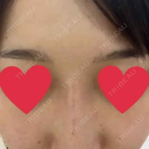 ヒアルロン酸注入（鼻） アクトリー勝どきウェルネスメディカルクリニック DAY 0
